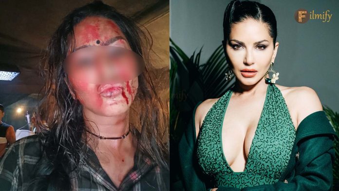 Sunny Leone : Bleeding from the mouth.. Star heroine in miserable condition..!